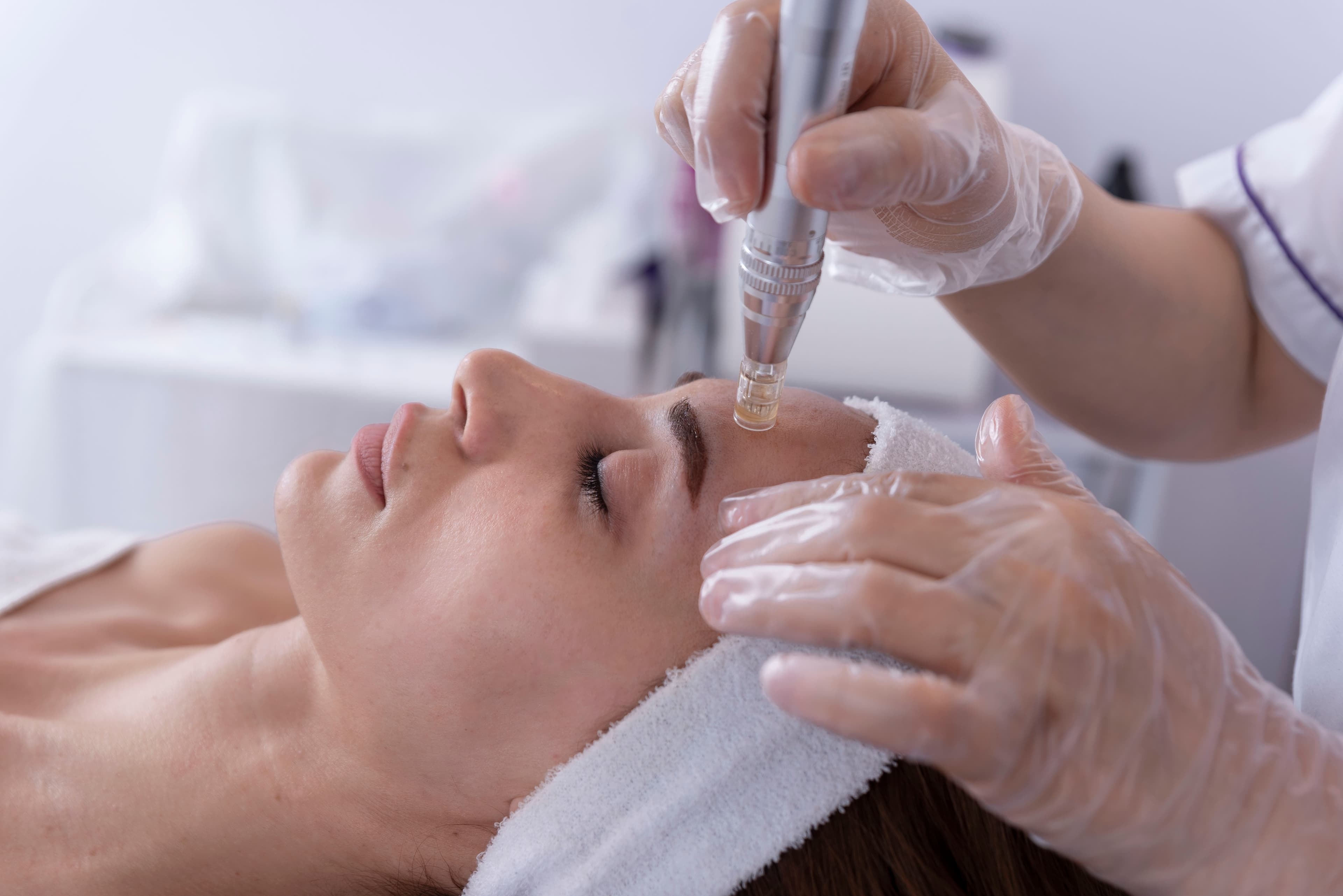 microneedling